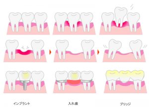 欠損補綴